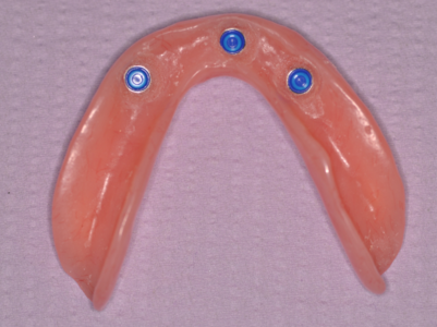 locator attachments in denture