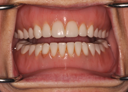 upper denture