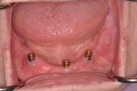 locator abutments in lower jaw